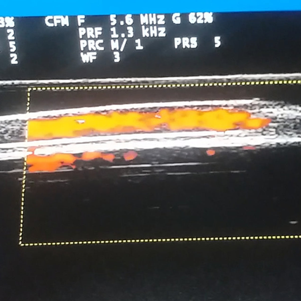 Ultrasound Guided PICC Placement Training Model